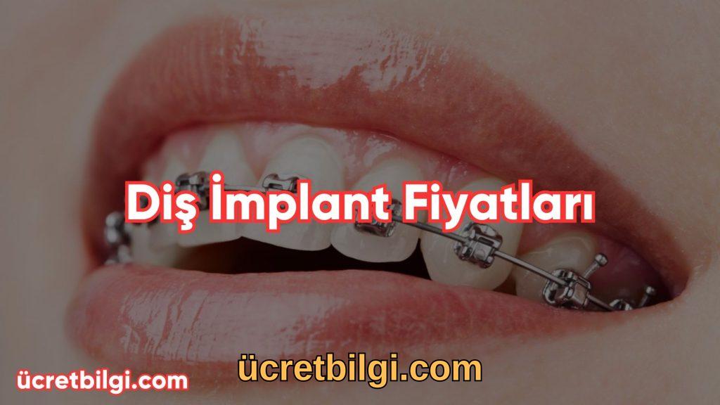 Dis Implant Fiyatlari